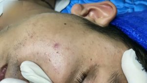 #774 Удаление акне. Экстракция комедонов. Подкожные прыщи. Чистка от черных точек