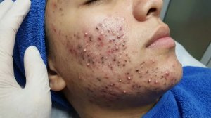 Удаление чёрных точек в Sac Dep Spa
