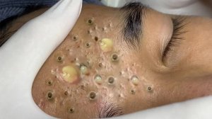 Экстремальное удаление черных точек: удовлетворение и релакс
