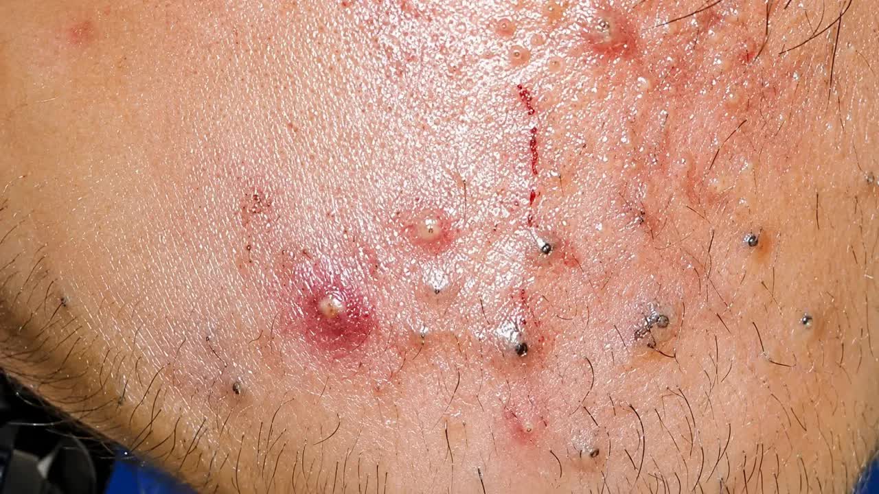 Deep Pore Cleansing — Acne | Satisfying Blackheads Korean Skincare Routine