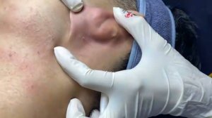 «Не для слабонервных» Выдавливание прыщей. Отличное качеств НОВОЕ