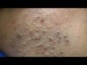 Глубокая очистка лица | Удаление черных точек