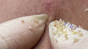 Only True Pimple Poppers & Snail Pickers Will Understand!  PART 16