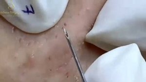 Лоан Нгуен — лечение акне