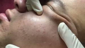 Удаление черных точек и прыщей на щеках. Часть 1