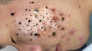 Extreme Blackhead Removal Satisfying Relaxing #1169