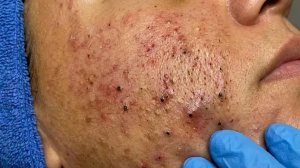Удаление черных точек в Today Spa