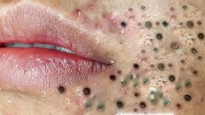 Экстремальное удаление черных точек: релакс и удовольствие