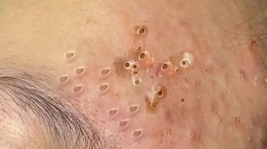 Экстремальное удаление черных точек: сатисфакция и релакс