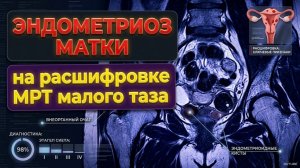 ЭНДОМЕТРИОЗ матки, КИСТА цистерны спинного мозга, МИОМА матки на РАСШИФРОВКЕ МРТ органов малого таза
