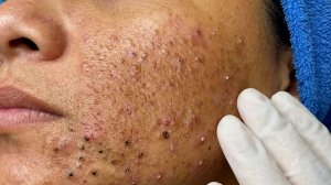 Удаление черных точек в Sac Dep Spa
