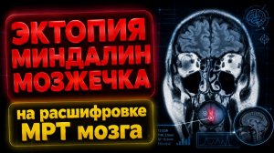 Признаки ВНУТРИЧЕРЕПНОГО ДАВЛЕНИЯ и ЭКТОПИЯ миндалин мозжечка на РАСШИФРОВКЕ МРТ головного мозга