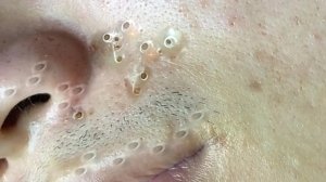 Экстремальное удаление черных точек: сатисфакция и релакс