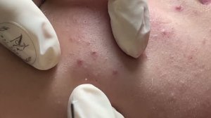 Удаление черных точек и прыщей на щеках. Часть 2