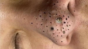 Экстремальное удаление черных точек: сатисфакция и релакс
