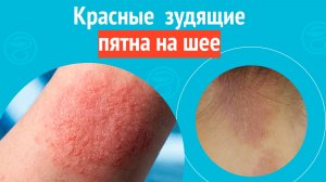 😡 Красные зудящие пятна на шее. Клинический случай № 1831