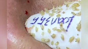 Выдавливание прыщей, угрей, черных точек и камедонов #703