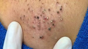 Удаление черных точек в Today Spa