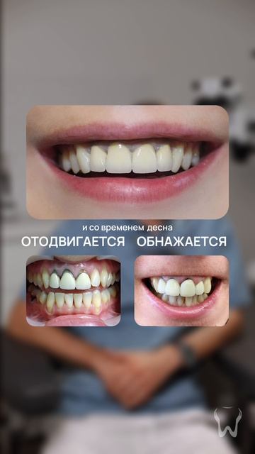Какой вид коронки выбрать