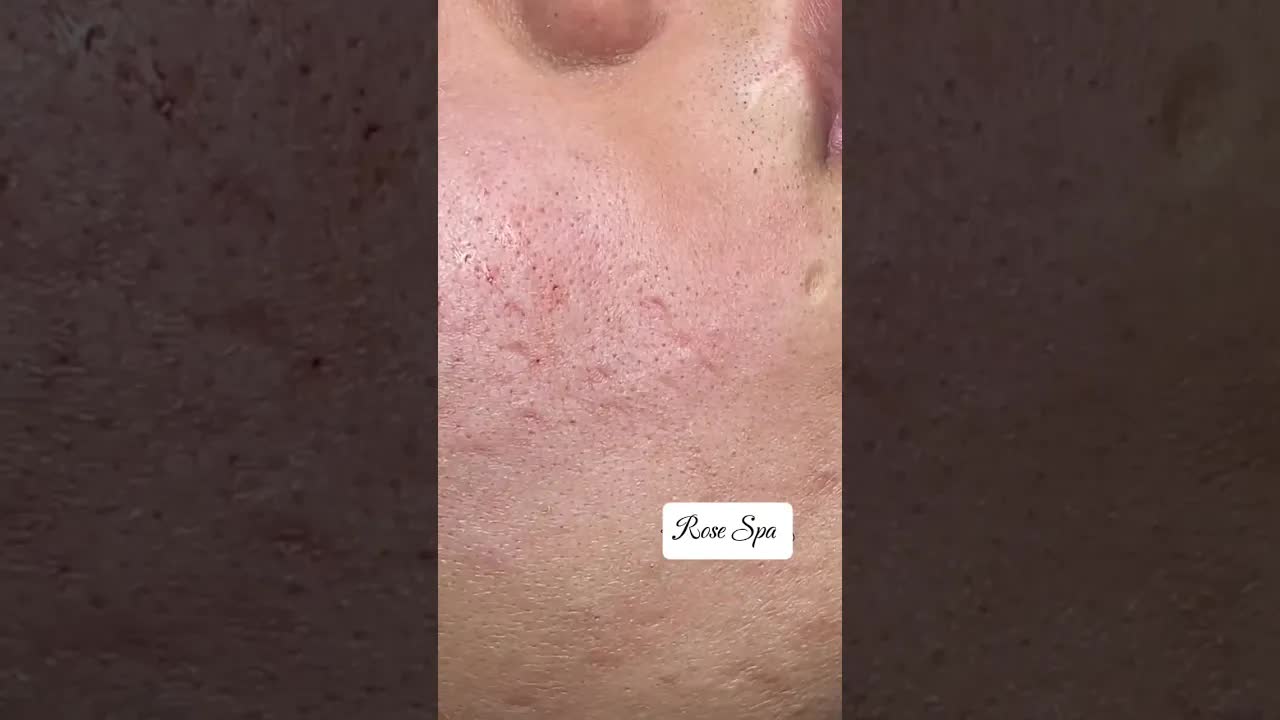 Расслабляющее удаление закрытых комедонов ASMR | Глубокая чистка пор