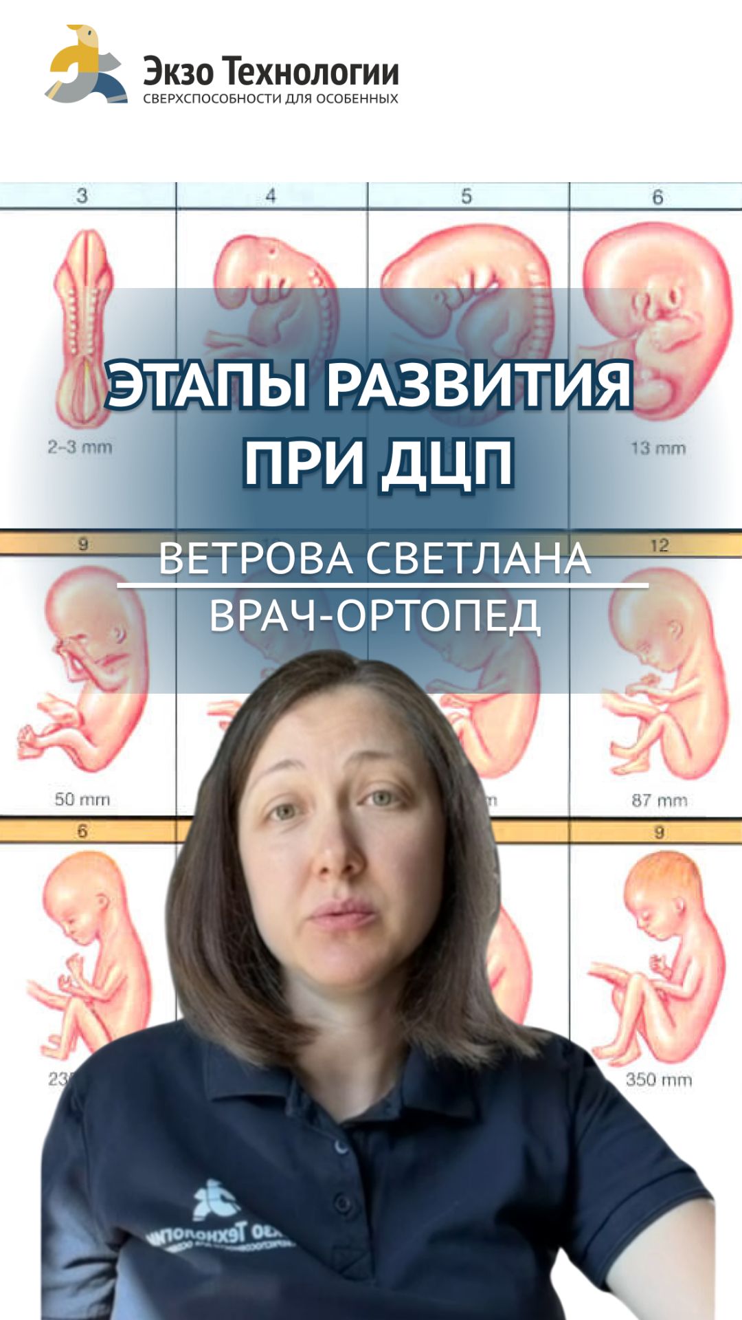 Обязательно ли ребенку с ДЦП сначала научиться ползать, и только потом ходить?