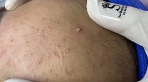 Удаление чёрных точек и прыщей – комплексно