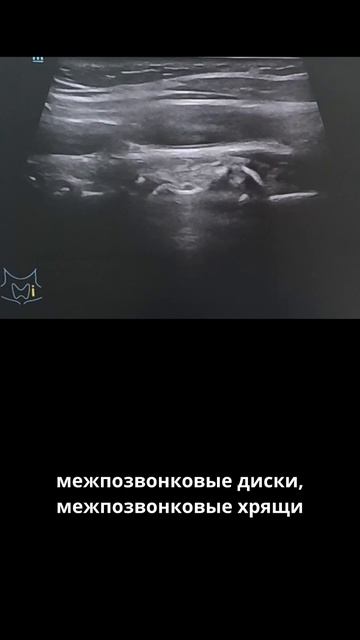 #экстравазальная компрессия