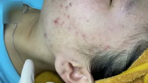 Чистка от прыщей – быстрый эффект