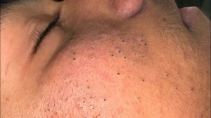 Глубокое очищение пор от черных точек и прыщей | Уход за лицом