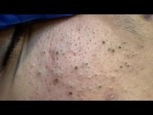 Уход за кожей | Лучшее средство от прыщей | Завораживающее удаление черных и белых точек