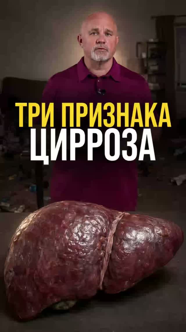Три признака цирроза печени