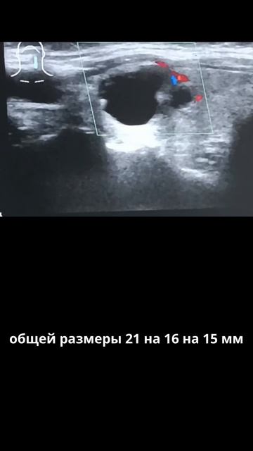 #узел ЩЖ