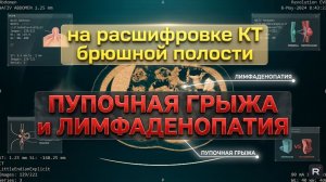 ПУПОЧНАЯ ГРЫЖА, ПЕРЕГИБ желчного пузыря и ЛИМФАДЕНОПАТИЯ на РАСШИФРОВКЕ КТ органов брюшной полости