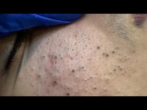 Удаление черных точек и белых угрей на лице | Ежедневный уход за кожей!