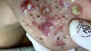Выдавливание прыщей. НОВОЕ! Угри. Акне. чистка лица