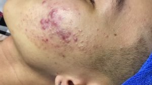 #817 Удаление акне. Экстракция комедонов. Подкожные прыщи. Чистка от черных точек