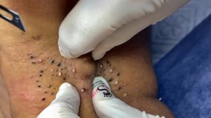 Удаление чёрных точек в спа-салоне Sac Dep Spa