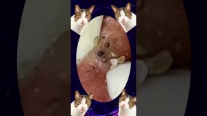 Удовлетворяющая чистка чёрных точек и прыщей