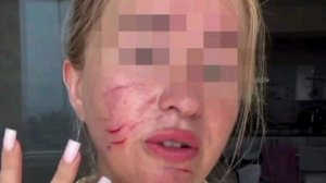 Ревнивая турчанка избила российскую туристку на пляже из-за подката мужа — девушку увезли на скорой.
