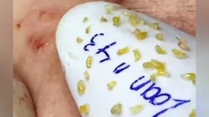 Выдавливание прыщей, угрей, черных точек и камедонов #707