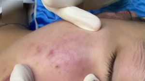 #815 Удаление акне. Экстракция комедонов. Подкожные прыщи. Чистка от черных точек