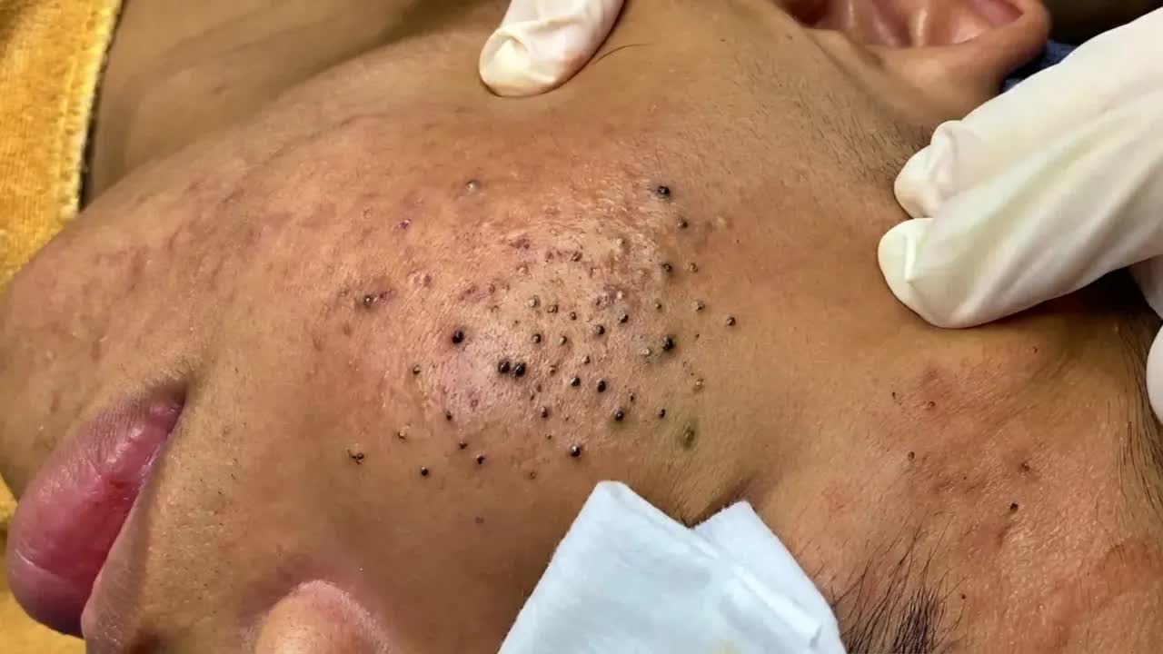 Удаление черных точек в Today Spa
