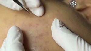 Экстракция акне механическим способом