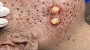 Выдавливание прыщей. «слабонервным не смотреть»
