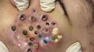 Выдавливание прыщей. НОВОЕ! Угри. Акне. чистка лица.