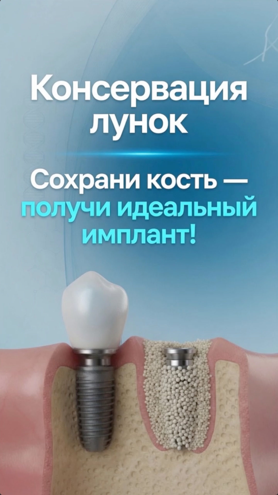 Консервация лунки: как сохранить кость после удаления зуба и заполнить зазор между имплантом,лункой?