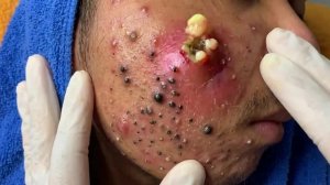 Удаление чёрных точек с Sac Dep Spa