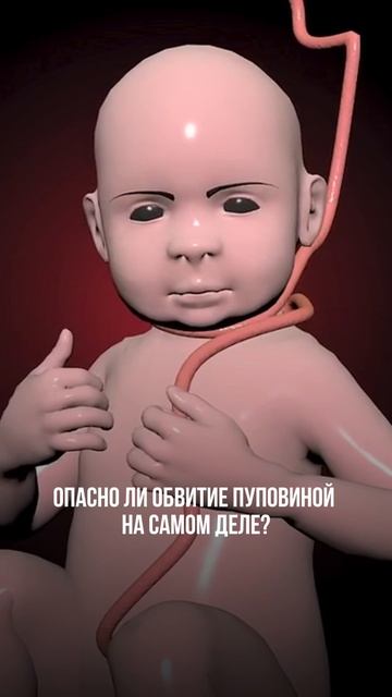 Обвитие пуповиной — слово, которое часто пугает. Но давайте по фактам