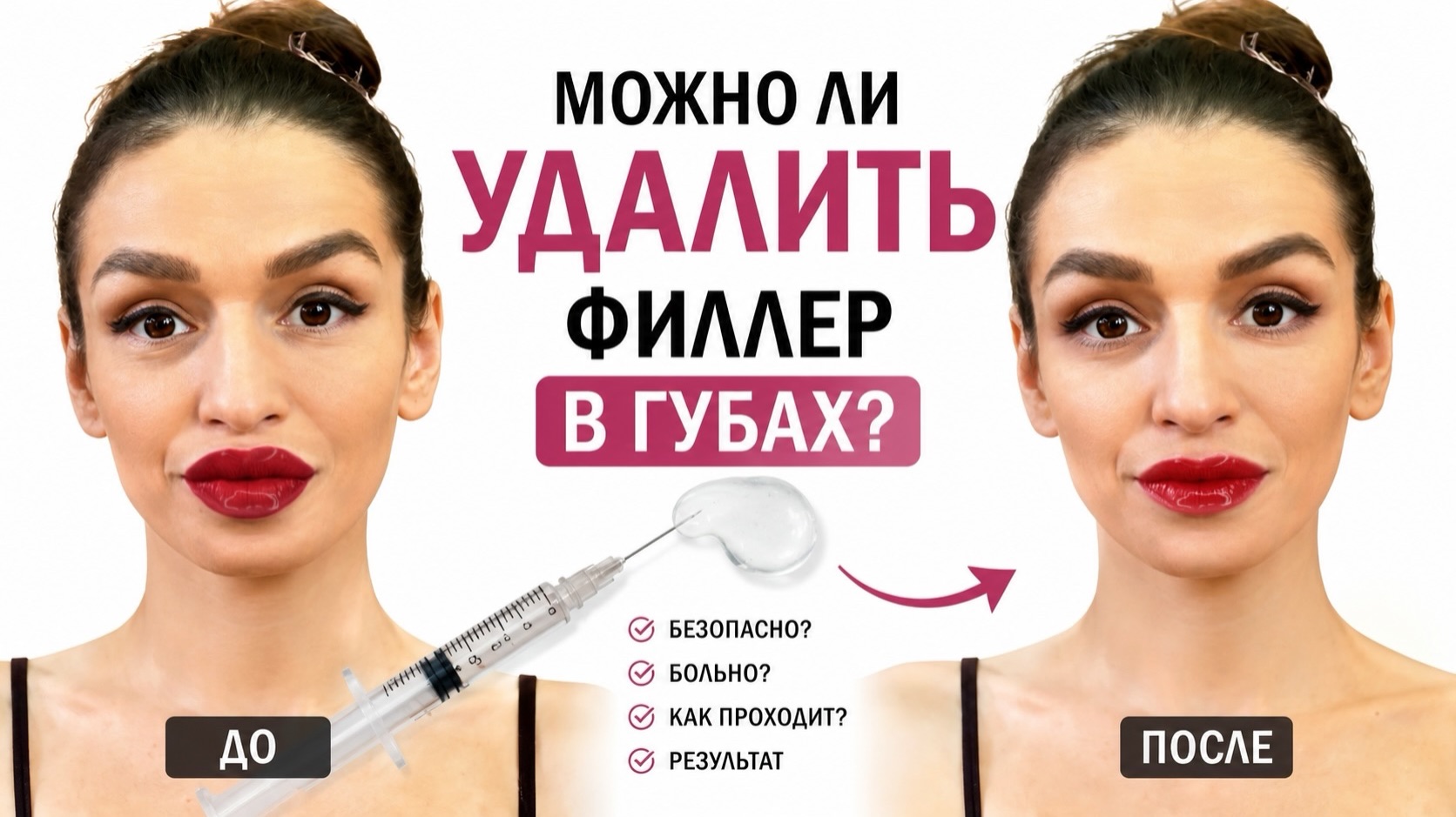 Можно ли филлер в губах удалили до или после