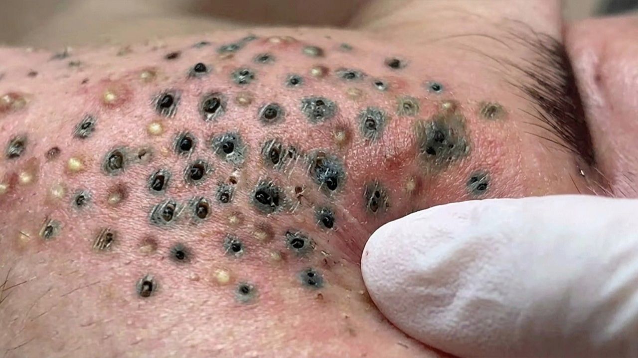 Выдавливание прыщей. «слабонервным не смотреть»